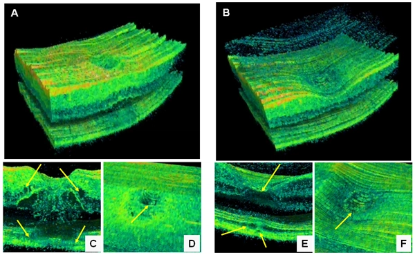 3D Retinal OCT scan showing multiple cross-sections