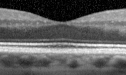 Normal fovea cross-section OCT scan